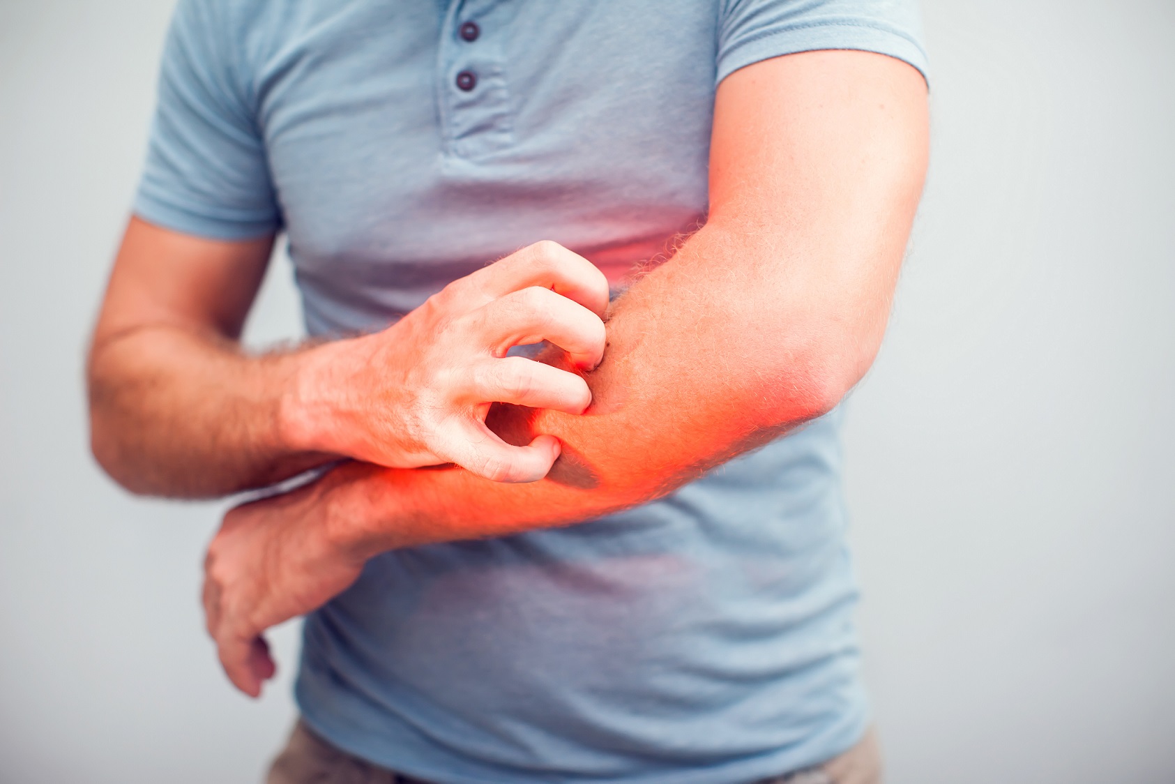 Eczema clinical trial at MAC