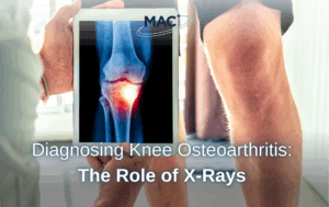 Diagnosing Knee Osteoarthritis The Role of X-Rays
