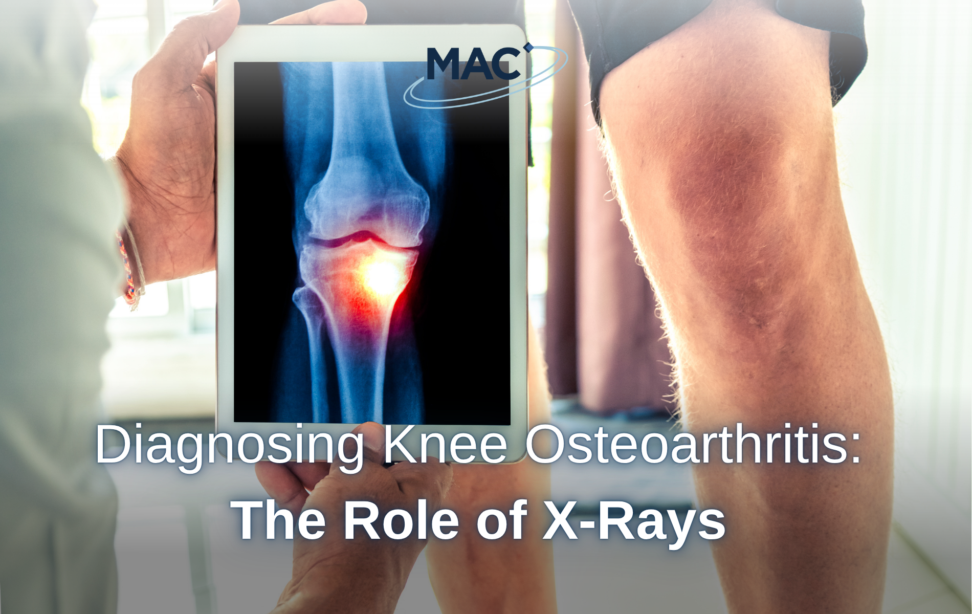 Diagnosing Knee Osteoarthritis The Role of X-Rays